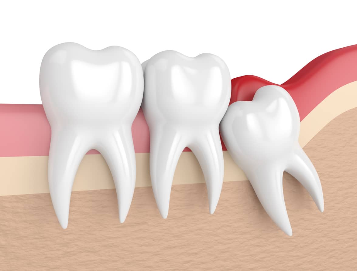 When is the Right Time to Remove Your Impacted Wisdom Teeth?