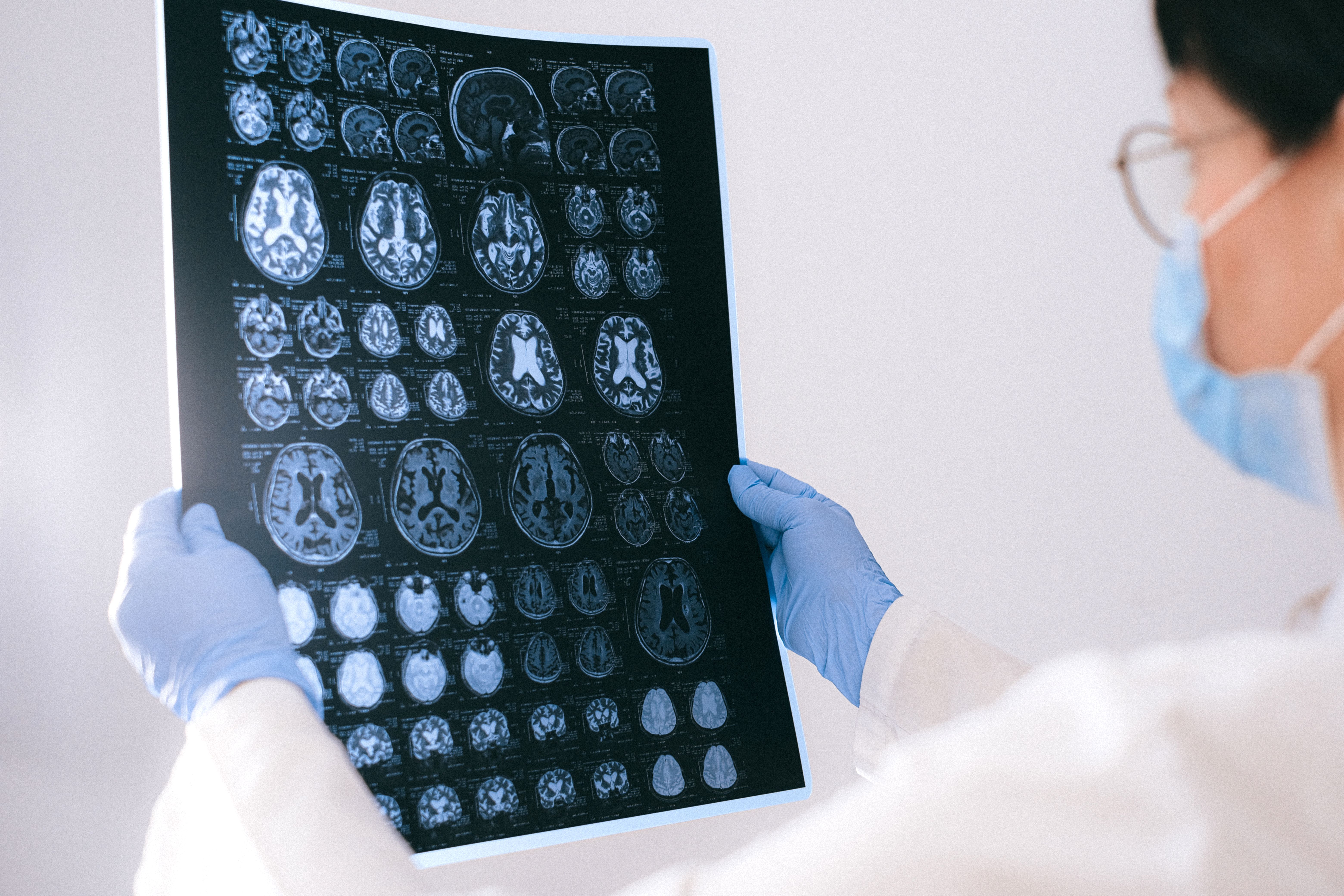 Apa Saja Faktor Pemicu Stroke dan Bagaimana Mencegahnya?