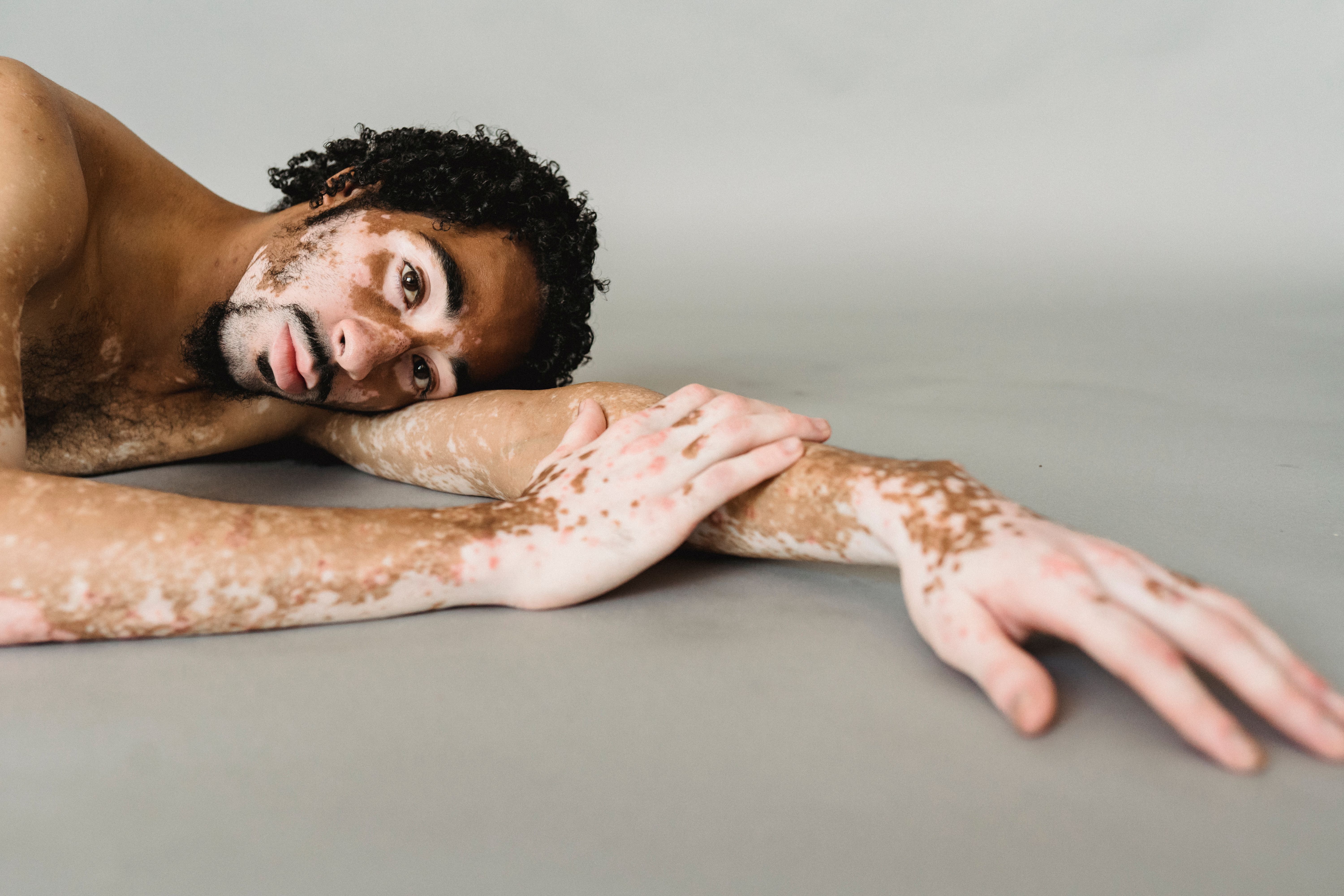 Apa Itu Psoriasis? Gejala, Penyebab, dan Cara Penanganannya