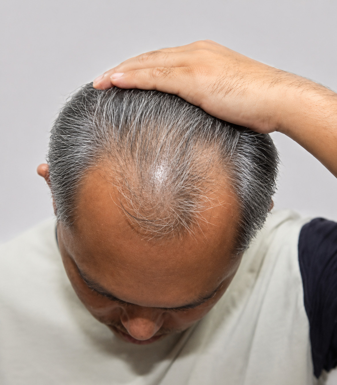 Rambut beruban rontok sebelum memakai Donan