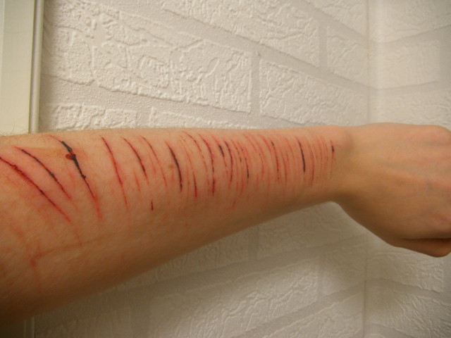 [Image: 3840px-Selfharmarm.jpg]